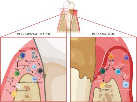 Natural Killer T Nkt Cells And Periodontitis Potential Regulatory Role Of Nkt Cells