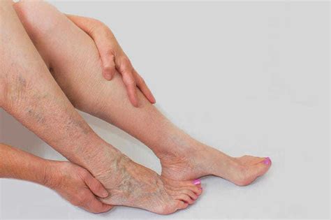 Varicose Veins In Pregnancy Causes And Prevention