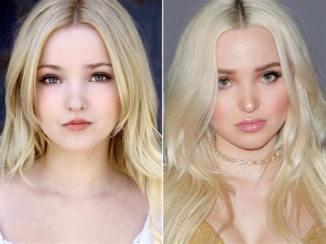 Dove Camerons Plastic Surgery Before And After Photos