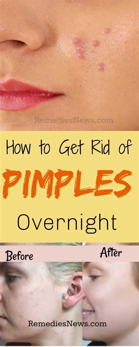 11 Effective Home Remedies To Get Rid Of Pimples And Acne Overnight At