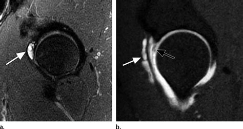 Paralabral Cysts A Sagittal Proton Density Weighted Fat Suppressed