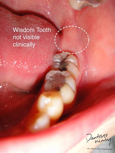 Do You Need Stitches For Wisdom Teeth Teethwalls