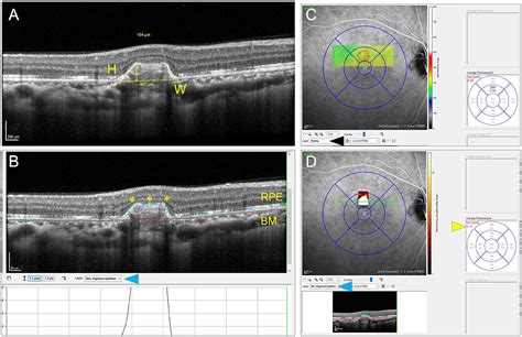 Frontiers Optical Coherence Tomography Findings Of Underlying