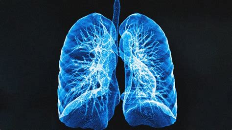 Extensive Stage Small Cell Lung Cancer Outlook And Survival