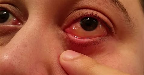 Watch Skin Crawling Moment Man Pops Blister On His Own Eyeball Mirror