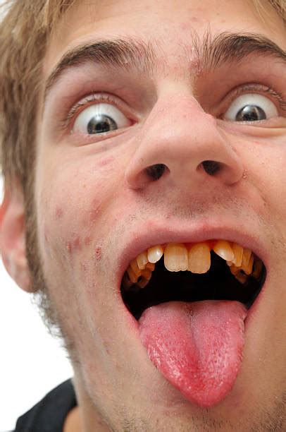 Top 60 Ugly Teeth Stock Photos Pictures And Images Istock