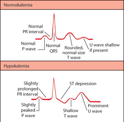 Usmle Cuny Sph Ekg Pattern In Hypokalemia