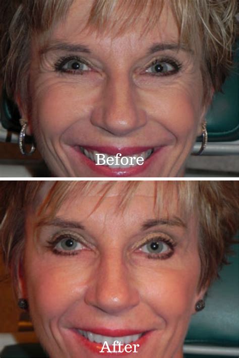 Check Out This Botox Before And After As We Focused On Eliminating Fine