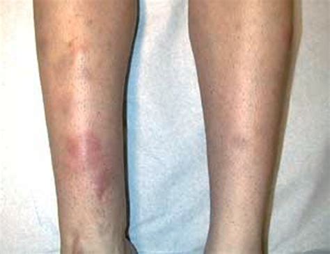 Erythema Nodosum Pictures Symptoms Causes And Treatment