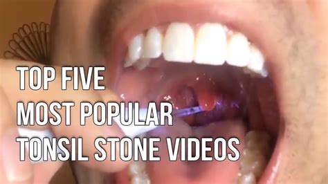 How To Remove Non Visible Tonsil Stones Howtomreov