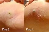 Images of Black Spot After Mole Removal