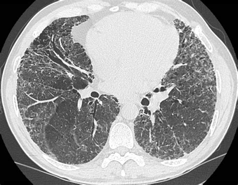 Interstitial Lung Disease Encompasses More Than 200 Disorders