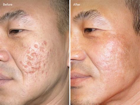 Facial Laser Treatments Before And After Before And After