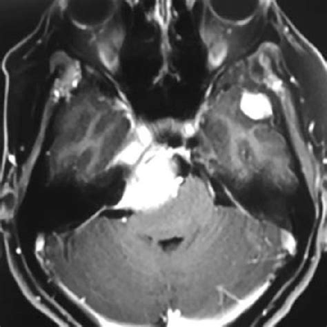 Gadolinium Enhanced T1 Weighted Axial Magnetic Resonance Image Showing