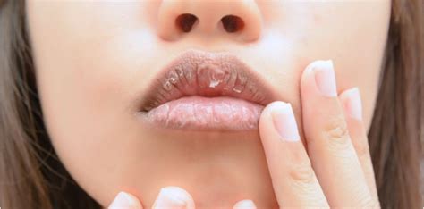 “jangan Jilat Bibir Anda” Ini 5 Tips Boleh Cuba Untuk Mengatasi Masalah Bibir Kering