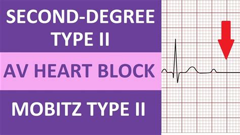 Second Degree Type 2 Heart Block Ecg Rhythm Nursing Nclex Mobitz Type