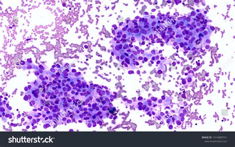 Microscopic Image Showing Cancer Cells Cytology Stock Photo Edit Now