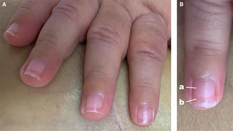 Terrys Nails In An Infant With Liver Cirrhosis Archives Of Disease