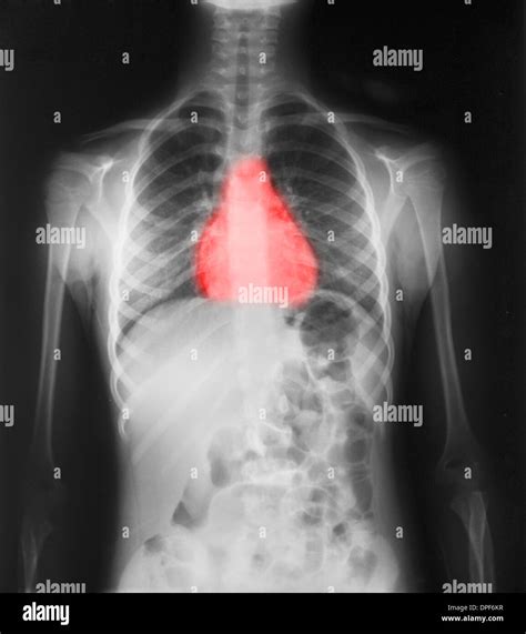 Normal Chest X Ray Of 7 Year Old Girl Stock Photo Alamy