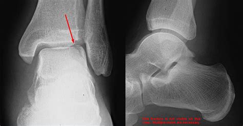 Osteochondral Fracture Talus My Xxx Hot Girl