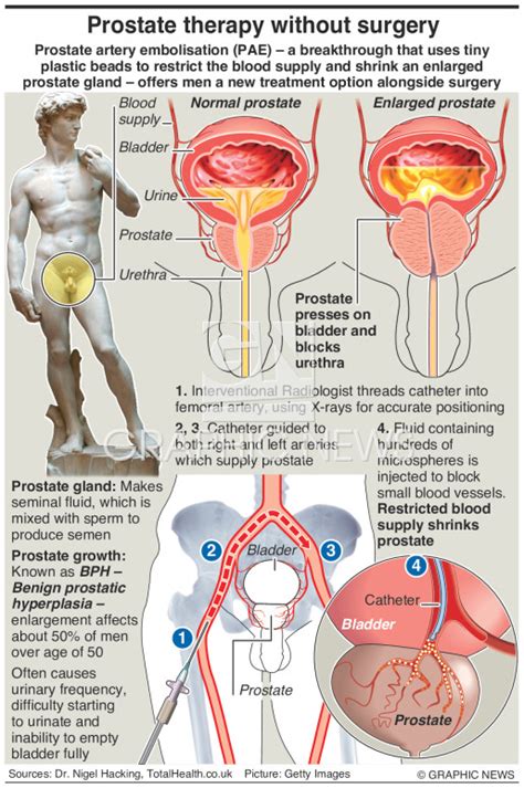 Medicine New Prostate Therapy Infographic