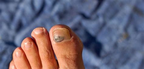 Do You Know The 9 Toe Nail Injuries Runners May Incur Wool It