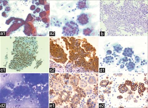 Cytologic Examination Of Ascitic Fluid In A Patient With Pleural Based