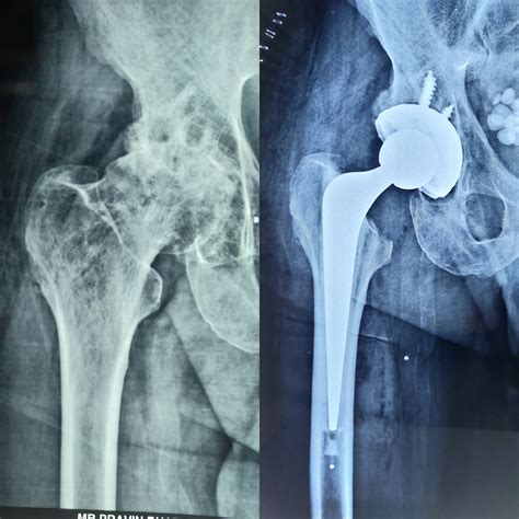 Total Hip Replacement Parts