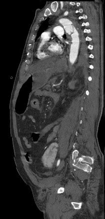 Aortic Transection Radiology Reference Article Radiopaedia Org