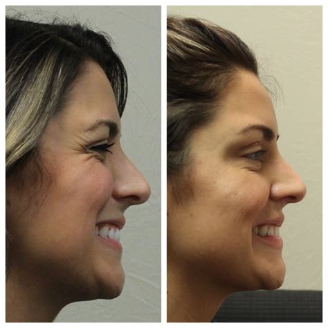 Maybe you would like to learn more about one of these? Wrinkle Reduction - Edmond OK | Edmond Family Eye Care