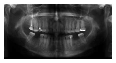 Conservative Management Of Keratocystic Odontogenic Tumors Of Jaws