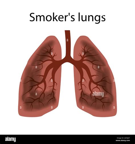 Smokers Lungs Damage To The Lungs Of A Person Caused By Smoking