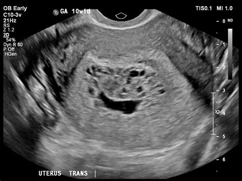 Molar Pregnancy Radiology Reference Article Radiopaedia Org