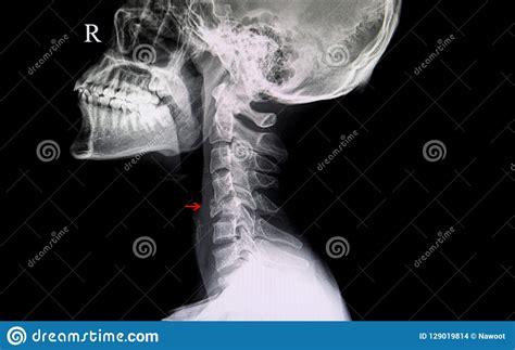 Fractured Cervical Spine Stock Photo Image Of Nerve 129019814