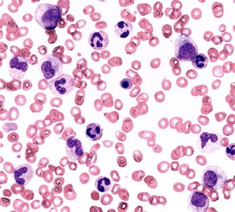 Leukoerythroblastic Picture Peripheral Blood Film Demonstrating A