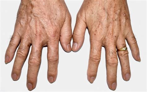 What Can I Do About Brown Aging Spots On My Hands