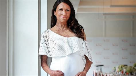 Turia Pitt On Pregnancy Ill Get A Baby From The Pain Gold Coast Bulletin