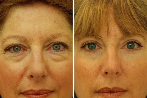 Endoscopic Brow Lift Eyelid Surgery Eye Lift For Women In New York