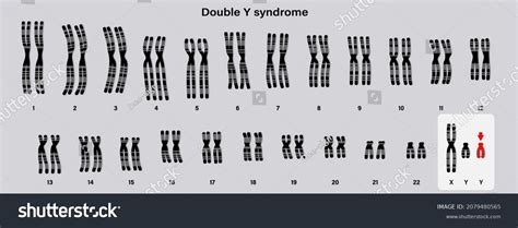 Human Karyotype Double Y Syndrome Xyy стоковая векторная графика без лицензионных платежей