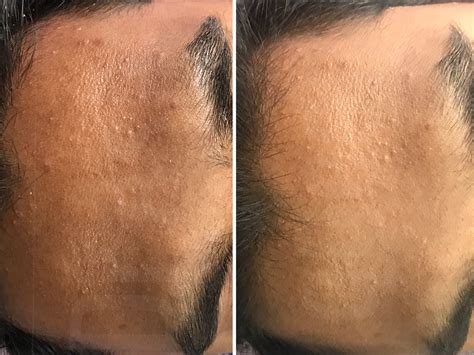 Forehead Pigmentation Treatment In Chennai Pigmentation Is Common And A
