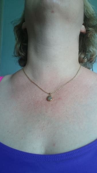 What Is This Swelling Above My Collar Bone Mumsnet