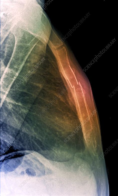 Fracture Of The Sternum X Ray Stock Image C0096806 Science