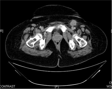 Computed Tomography Of Pelvis Showing Enlarged Left Inguinal Lymph Node