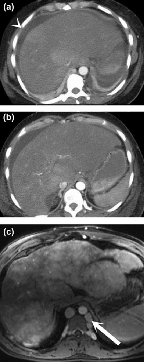 Acute Versus Chronic Budd Chiari Syndrome Postcontrast Axial Ct Images