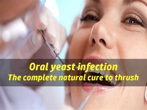 Yeast Infection In Mouth The Natural Treatment To Oral