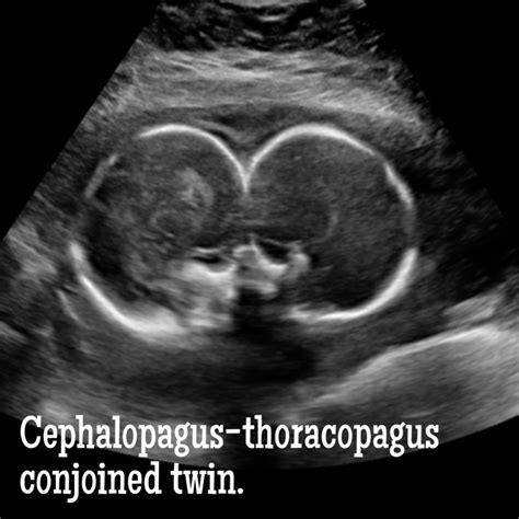 Facts About Conjoined Twins Everyone Should Know Ultrasoundfeminsider