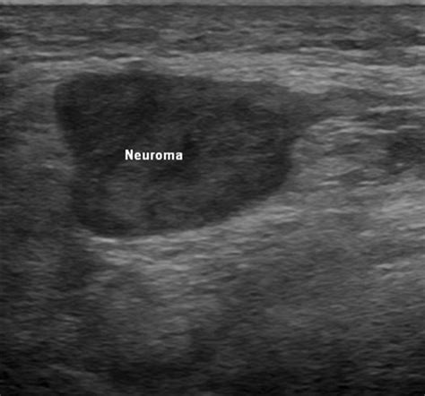 Ultrasound Guided Neuroma Injection