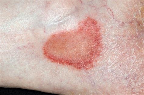 Ringworm Fungal Infection Bild Kaufen 11652191 Science Photo Library