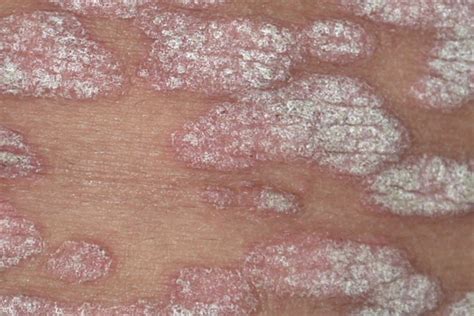 Topical Management Of Recalcitrant Psoriasis And Eczema