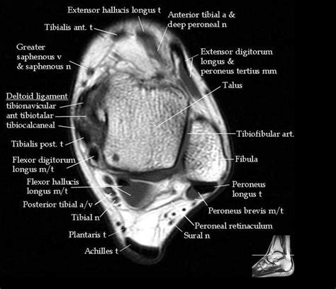 This is the first of two parts on the intrinsic muscles of the foot. 52 best images about MRI anatomy on Pinterest | Head and ...